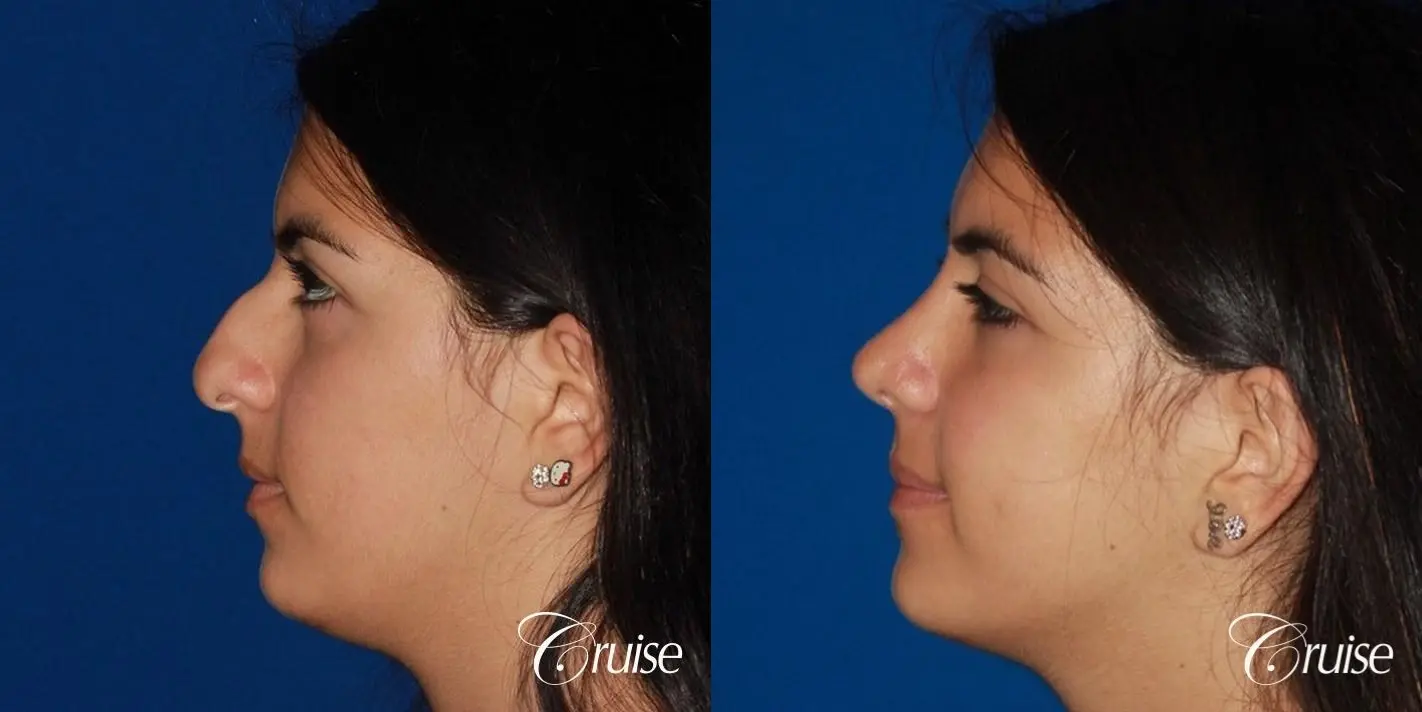 Rhinoplasty: Dorsal Hump & Droopy Tip Correction - Before and After 2