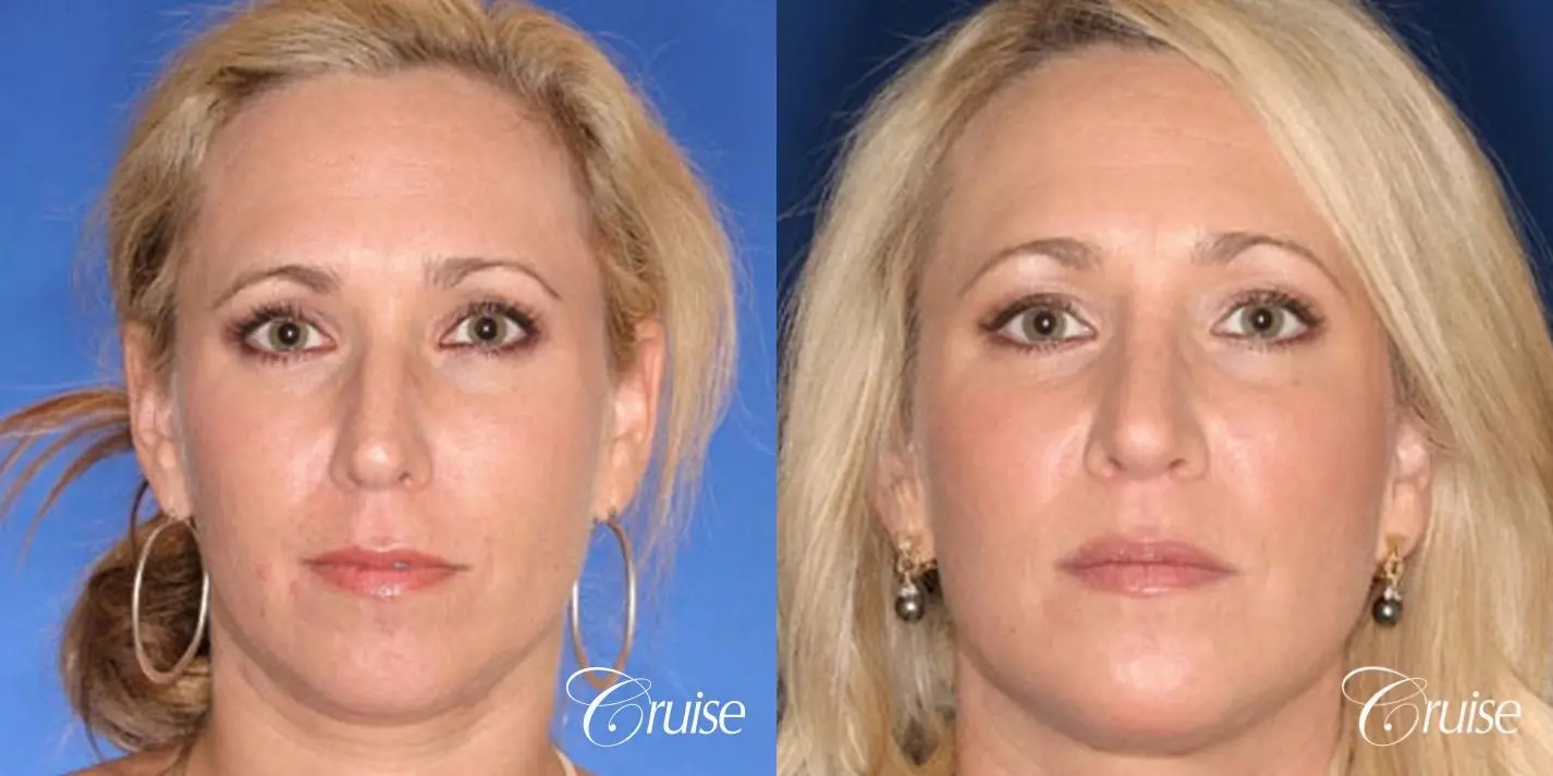 Rhinoplasty: Dorsal Hump & Droopy Tip Correction - Before and After 1