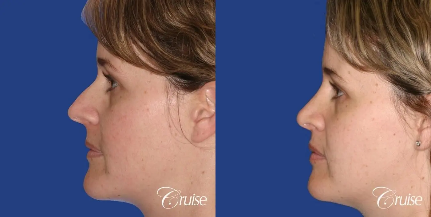 Rhinoplasty: Dorsal Hump Reduction - Before and After 2