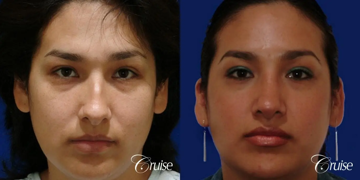 Rhinoplasty: Dorsal Hump Reduction  - Before and After 1