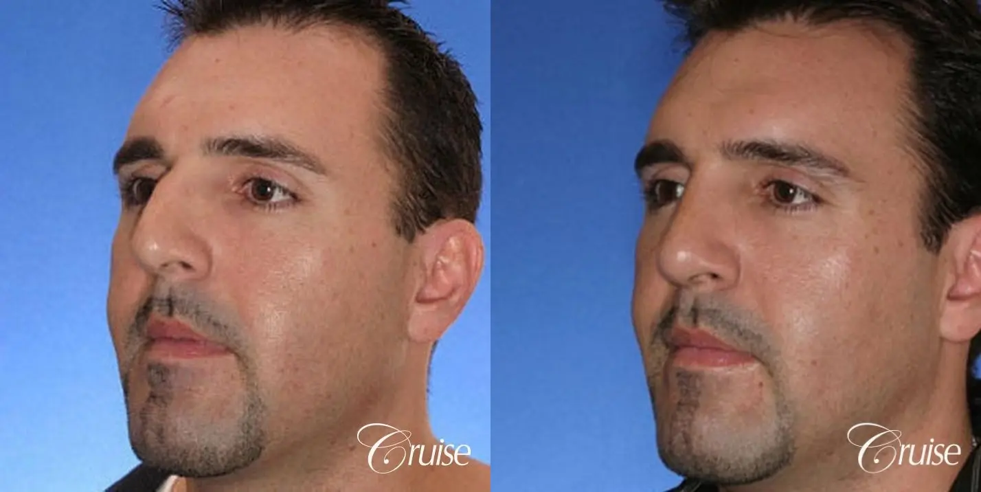 Rhinoplasty: Dorsal Hump Correction  - Before and After 3