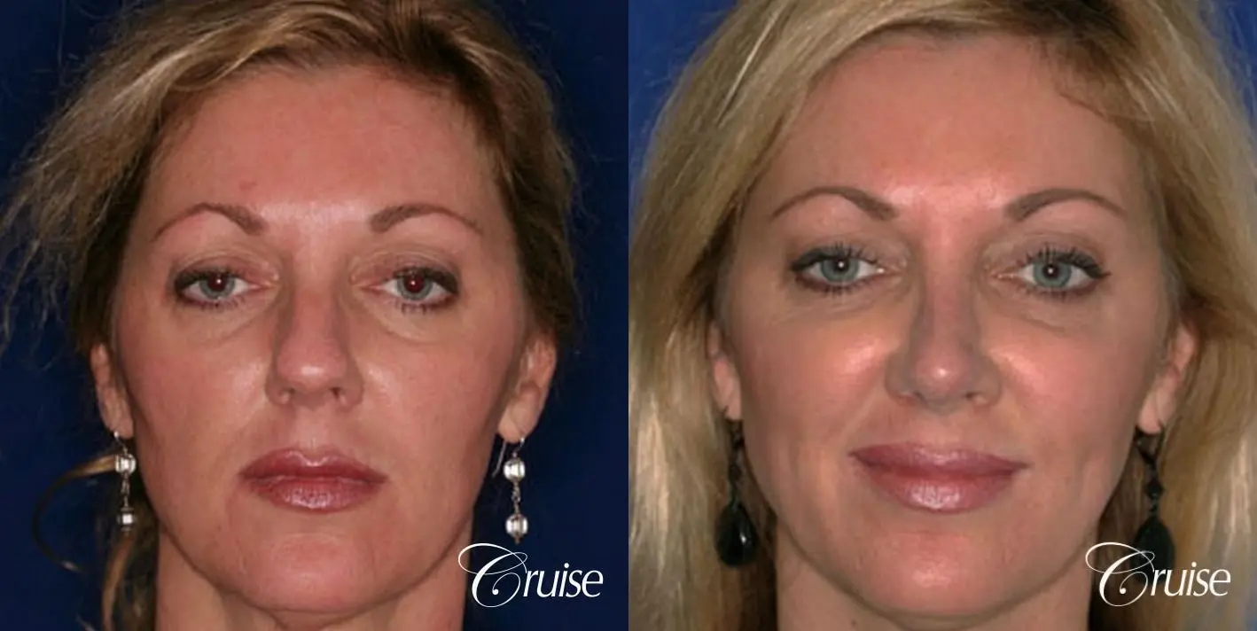 Rhinoplasty: Nose Reshaping  - Before and After 1