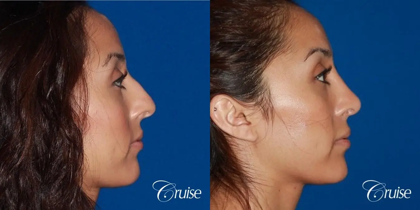 Rhinoplasty: Dorsal Hump Reduction & Droopy Tip Correction  - Before and After 4