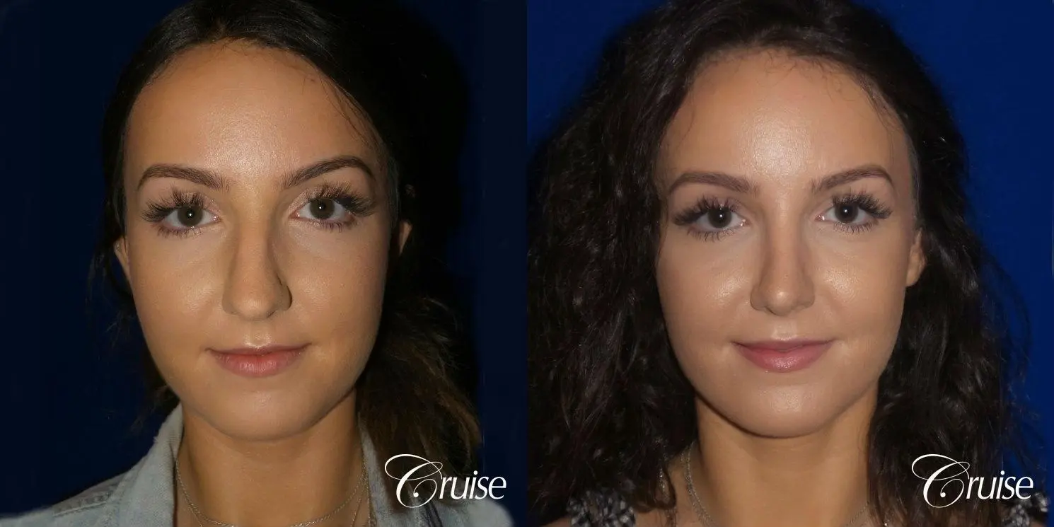 Rhinoplasty Dr. Cruise newport beach - Before and After