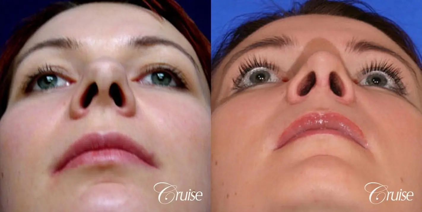 Rhinoplasty: Dorsal Hump, Nose Narrowing, Tip Definition  - Before and After 3