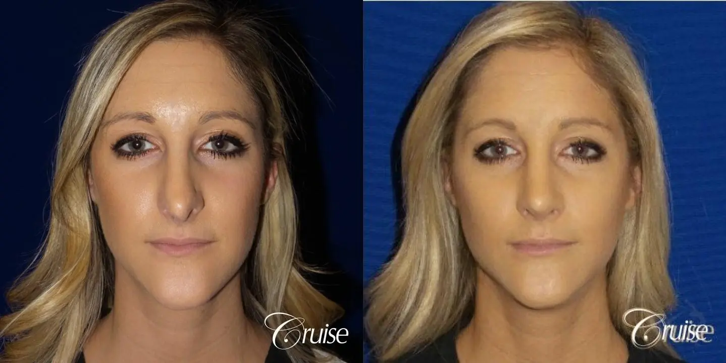 Best Rhinoplasty results Newport Beach CA - Before and After 1