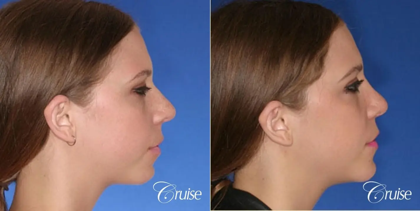 Rhinoplasty Revision w/ Chin Augmentation  - Before and After 3