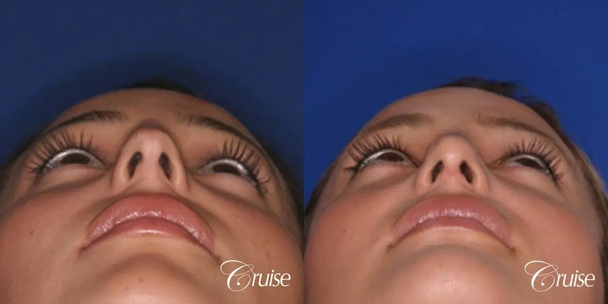 Rhinoplasty: Dorsal Hump Reduction - Before and After 3