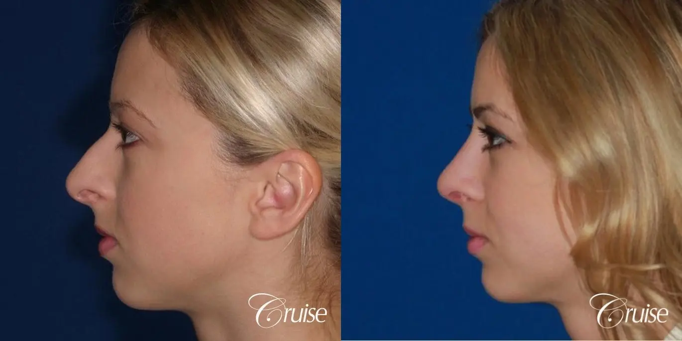 Rhinoplasty: Dorsal Hump Reduction  - Before and After 3