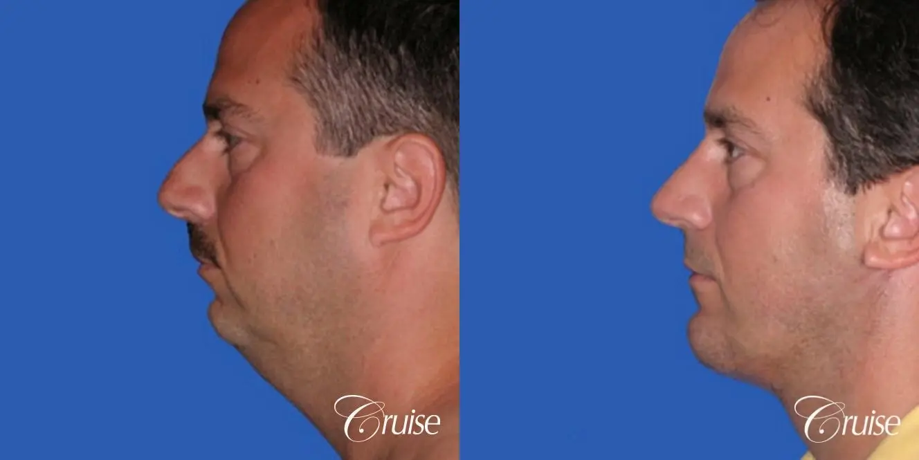 Rhinoplasty w/ Chin Augmentation and Neck Lift - Before and After 2
