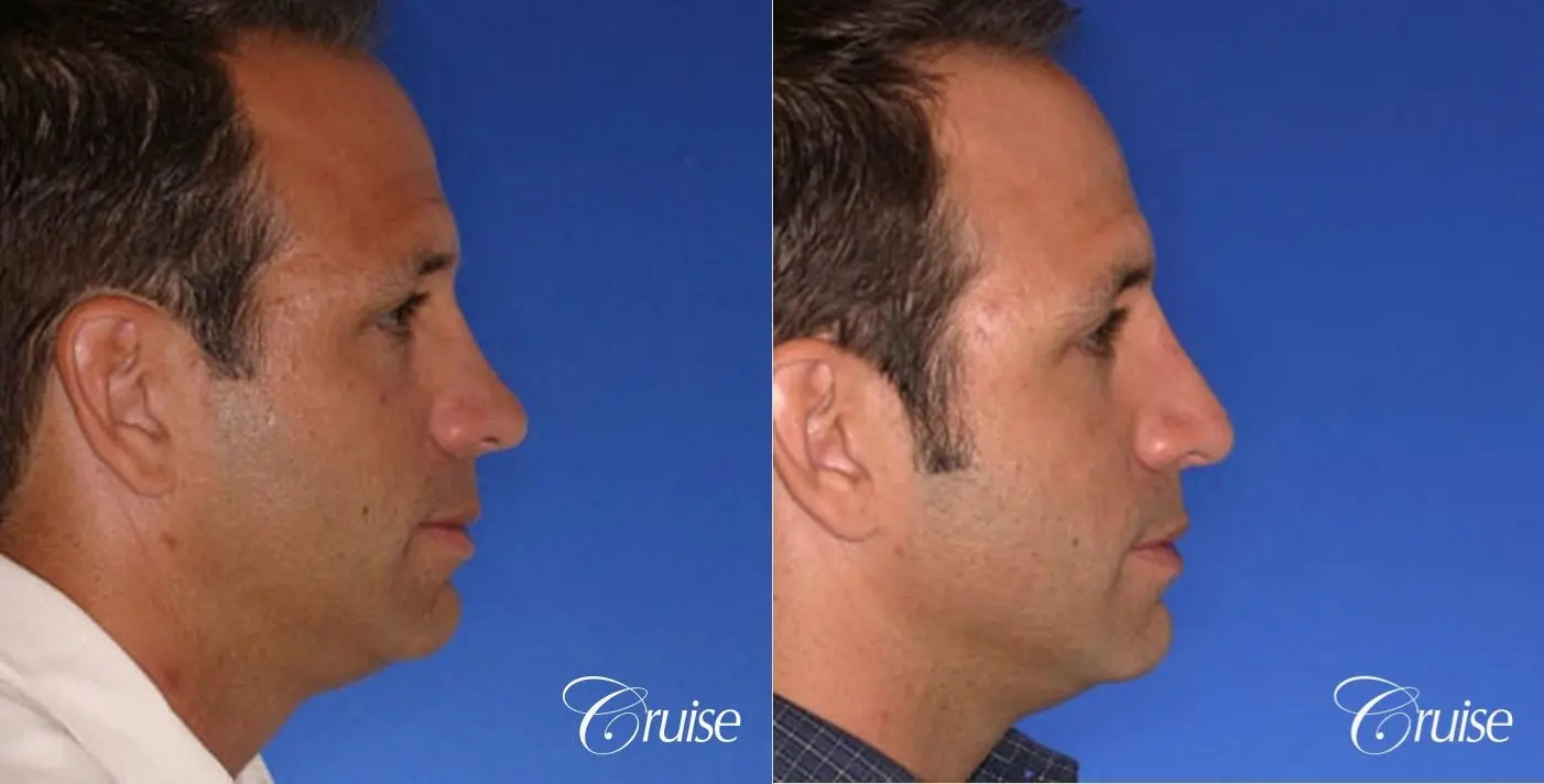 Rhinoplasty Revision: Correction of Ski Sope Deformity, Loss of Dorsal Lines - Before and After 2