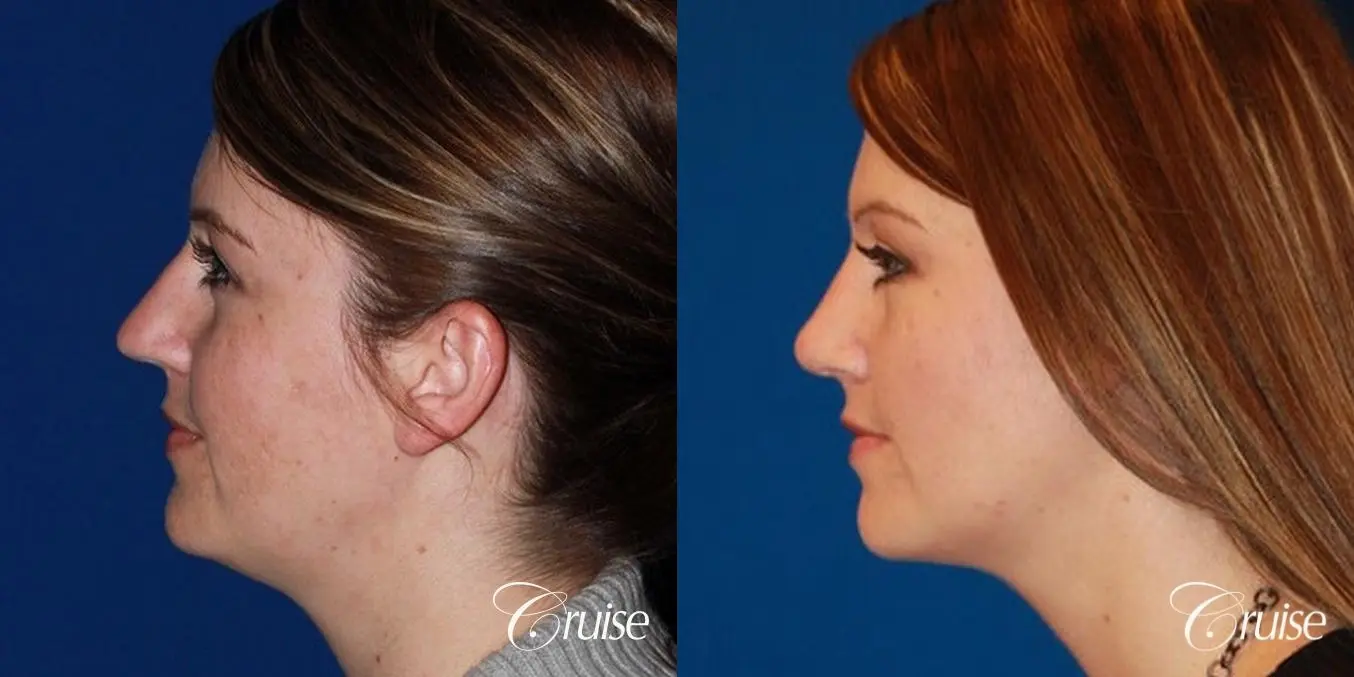 Rhinoplasty: Bridge Narrowing - Before and After 2