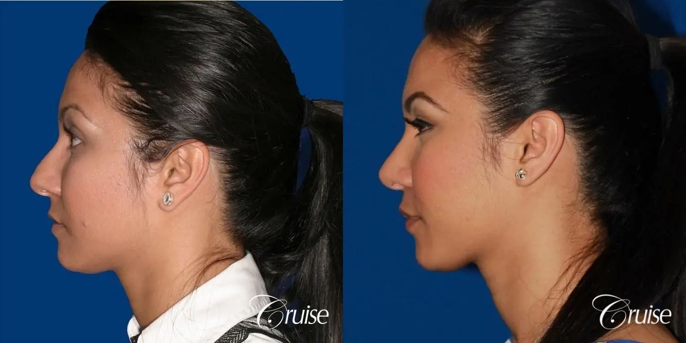 Rhinoplasty: Dorsal Hump Correction  - Before and After 2