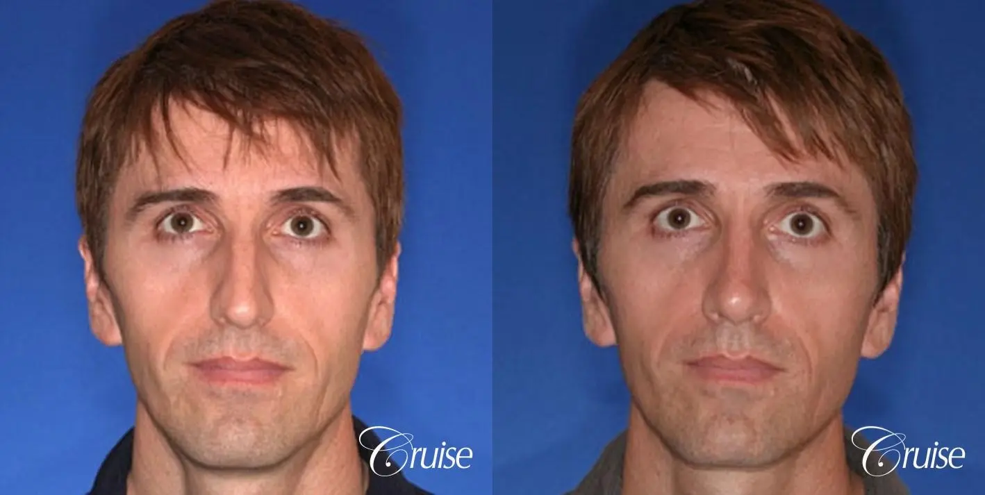 Rhinoplasty: Dorsal Hump Correction  - Before and After 1