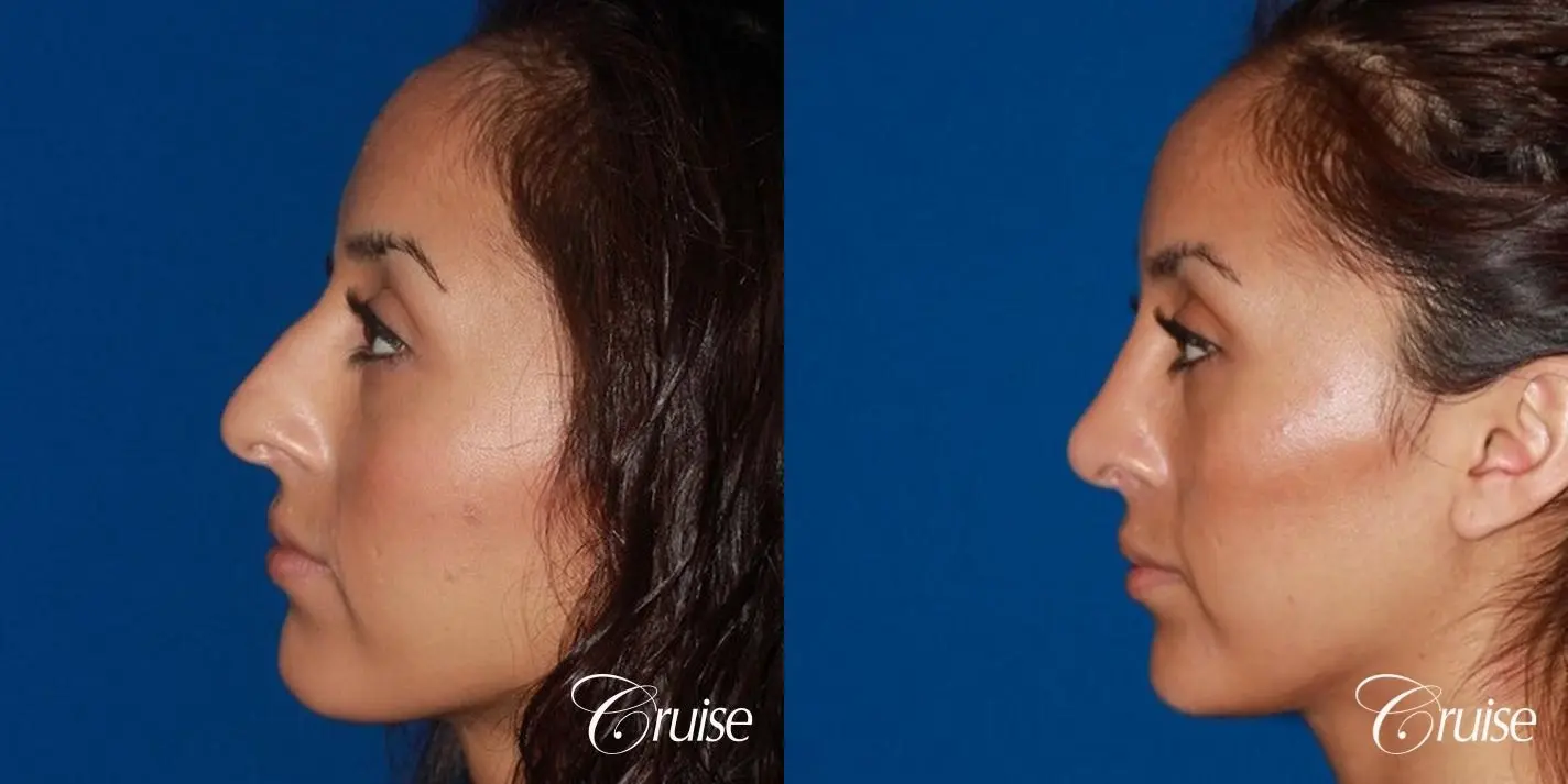 Rhinoplasty: Dorsal Hump Reduction & Droopy Tip Correction  - Before and After 2