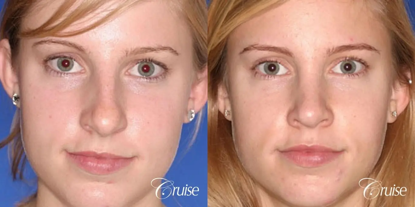 Rhinoplasty: Hump Reduction & Tip Narrowing  - Before and After 1