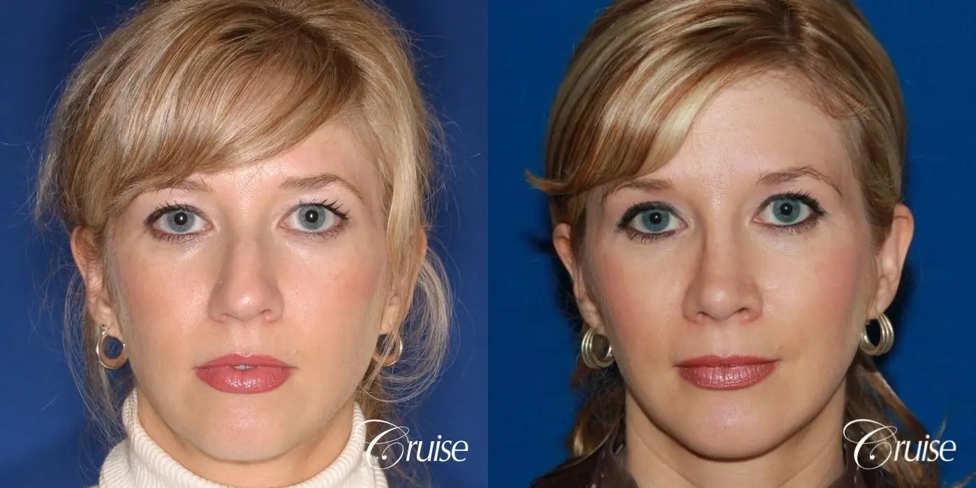 Rhinoplasty w/ Chin Augmentation & Temple Lift - Before and After 1