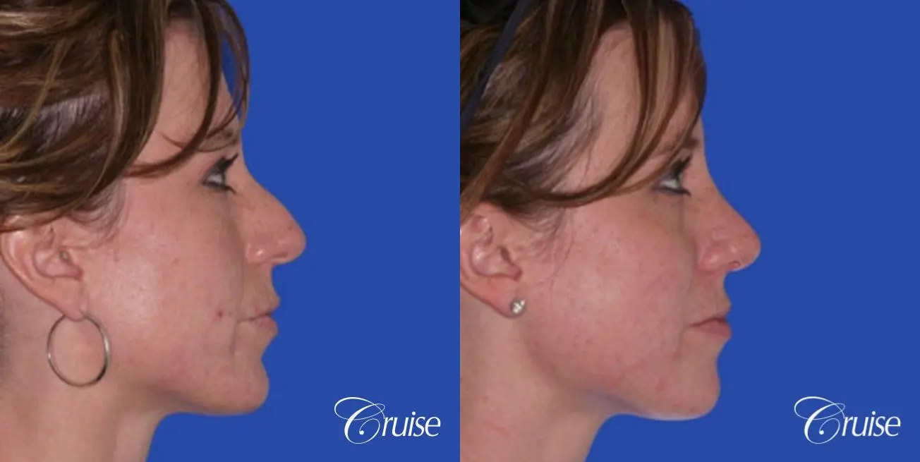 Rhinoplasty: Nose Refinement  - Before and After 2