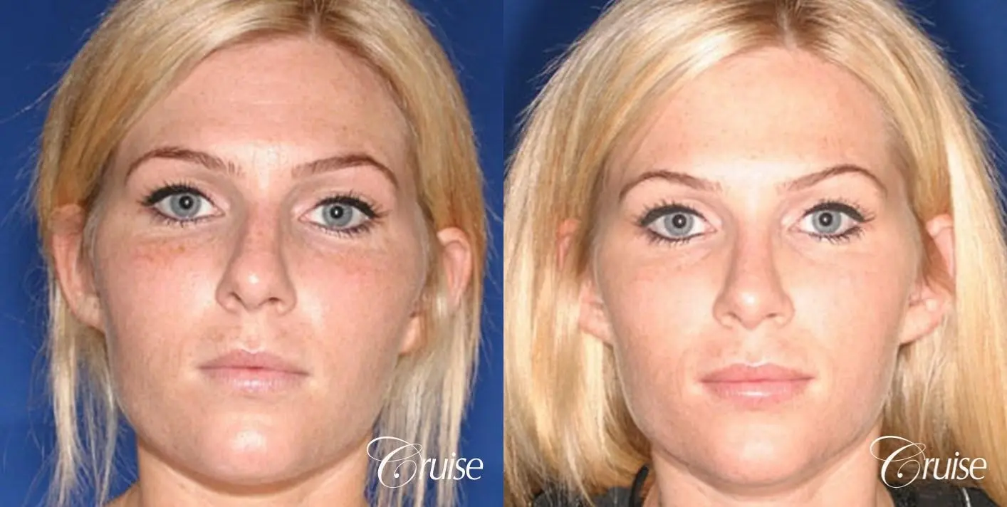 Rhinoplasty Revision: Tip Definition & Rotation  - Before and After 1