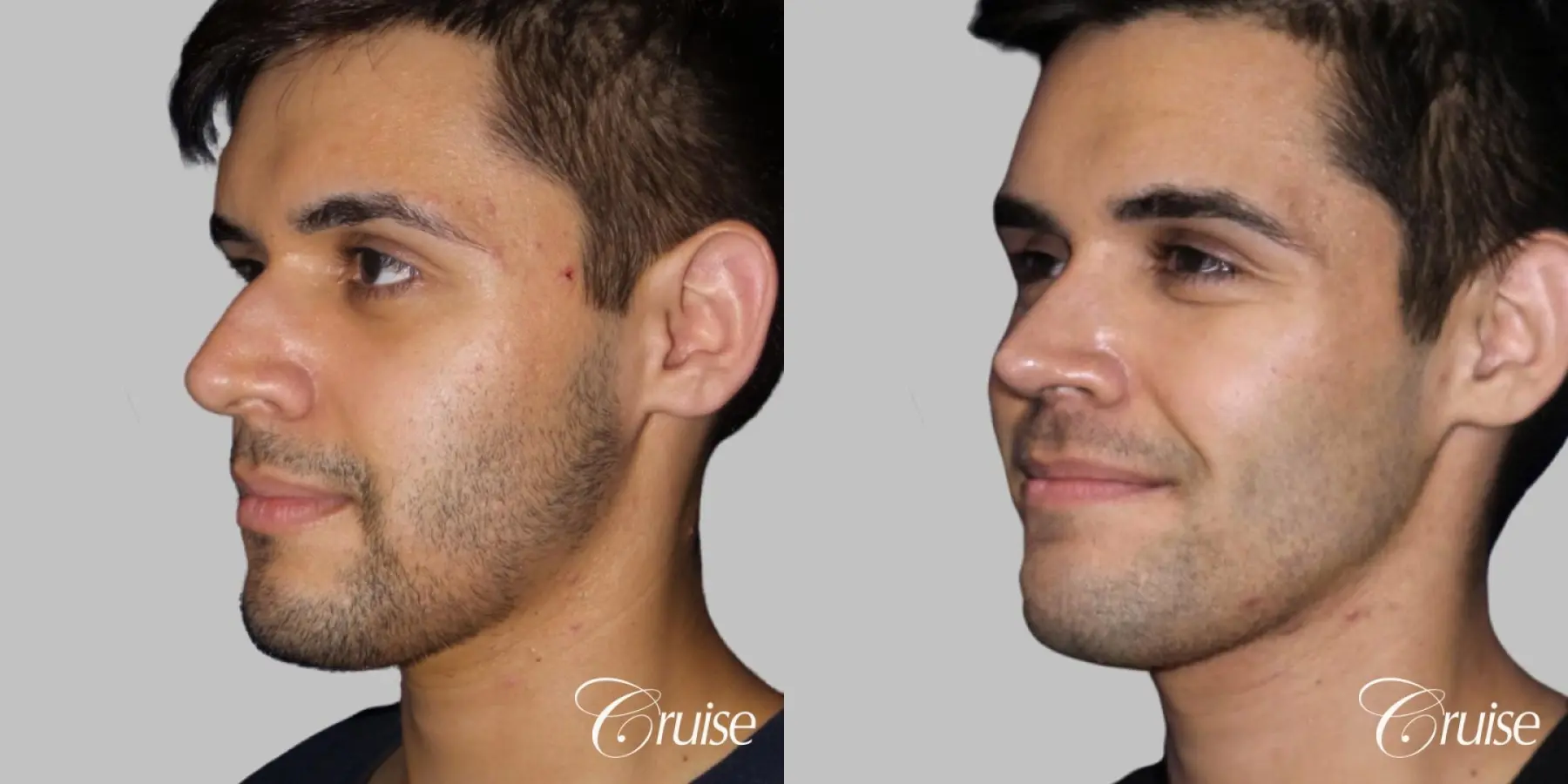 Rhinoplasty with Fat Transfer to Tear Troughs and Cheeks - Before and After 2