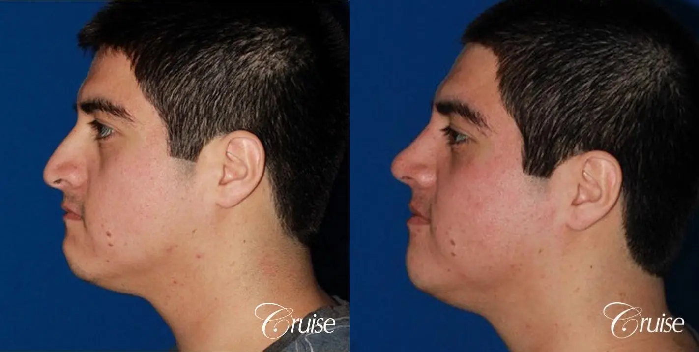 Rhinoplasty: Dorsal Hump & Droopy Tip Correction - Before and After 2