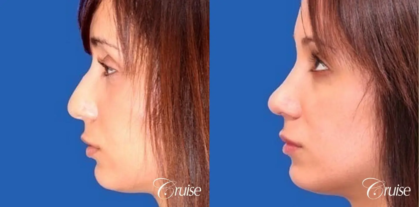 Rhinoplasty: Dorsal Hump Correction  - Before and After 2