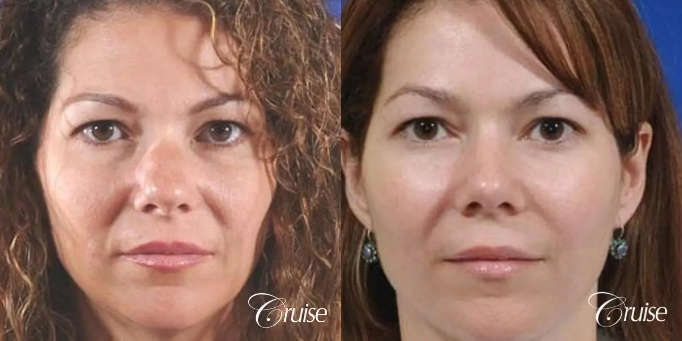 Rhinoplasty: Nose Lengthening & Bulbous Tip Correction - Before and After 1