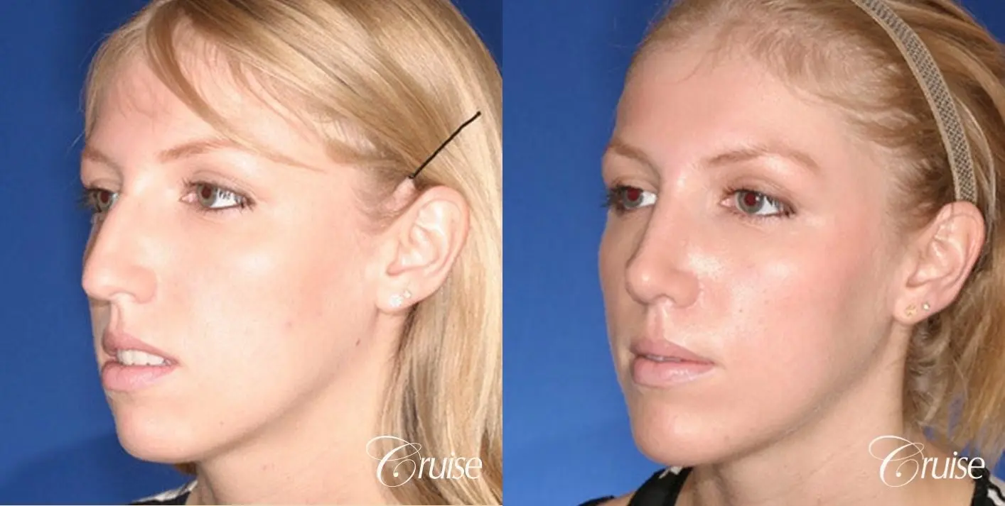 Rhinoplasty w/ Chin Augmentation: Hump Reduction  - Before and After 2
