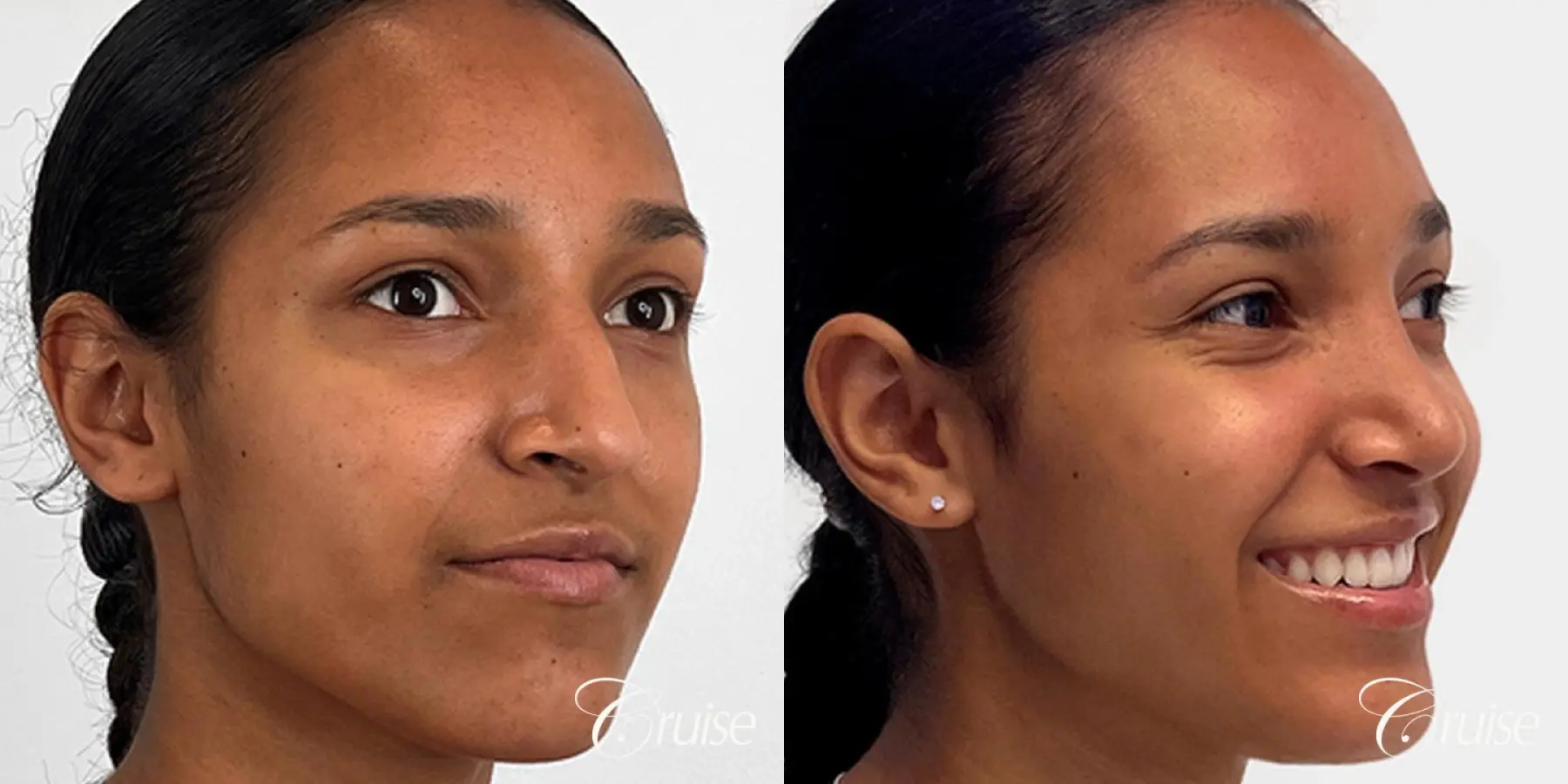 Open Ethnic Rhinoplasty - Before and After 3
