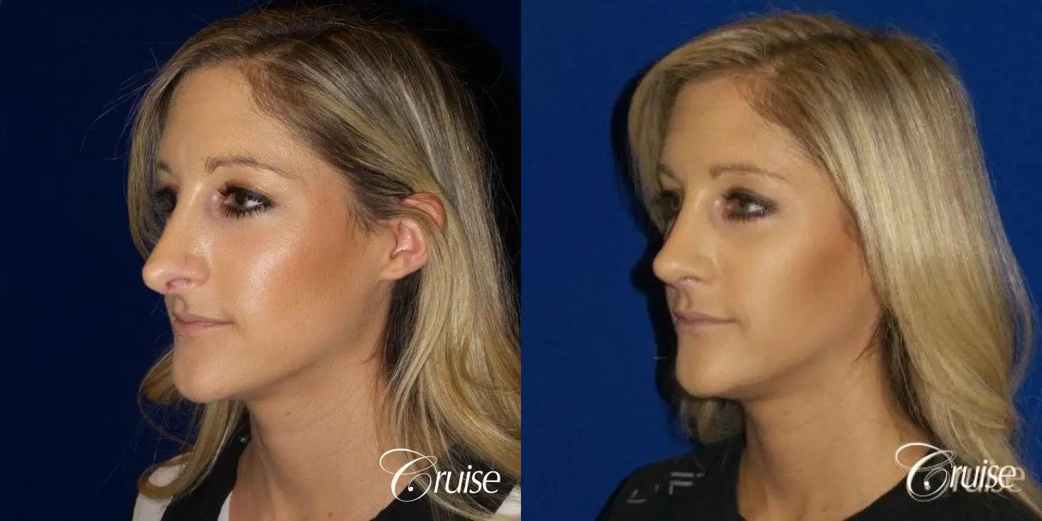 Best Rhinoplasty results Newport Beach CA - Before and After 3