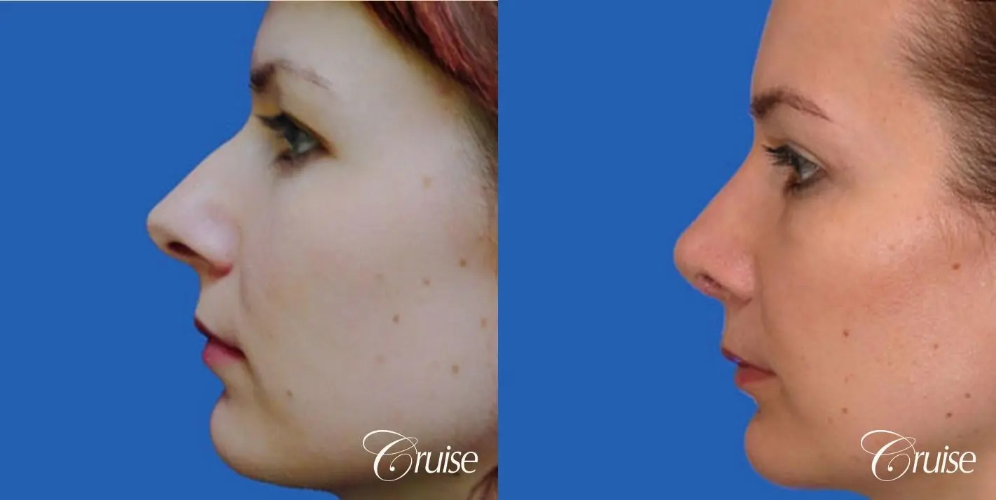 Rhinoplasty: Dorsal Hump, Nose Narrowing, Tip Definition  - Before and After 2