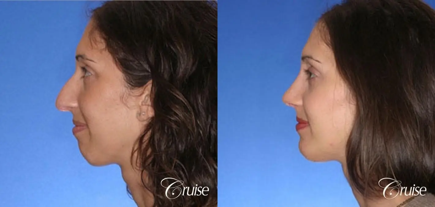 Rhinoplasty w/ Chin Augmentation  - Before and After 2