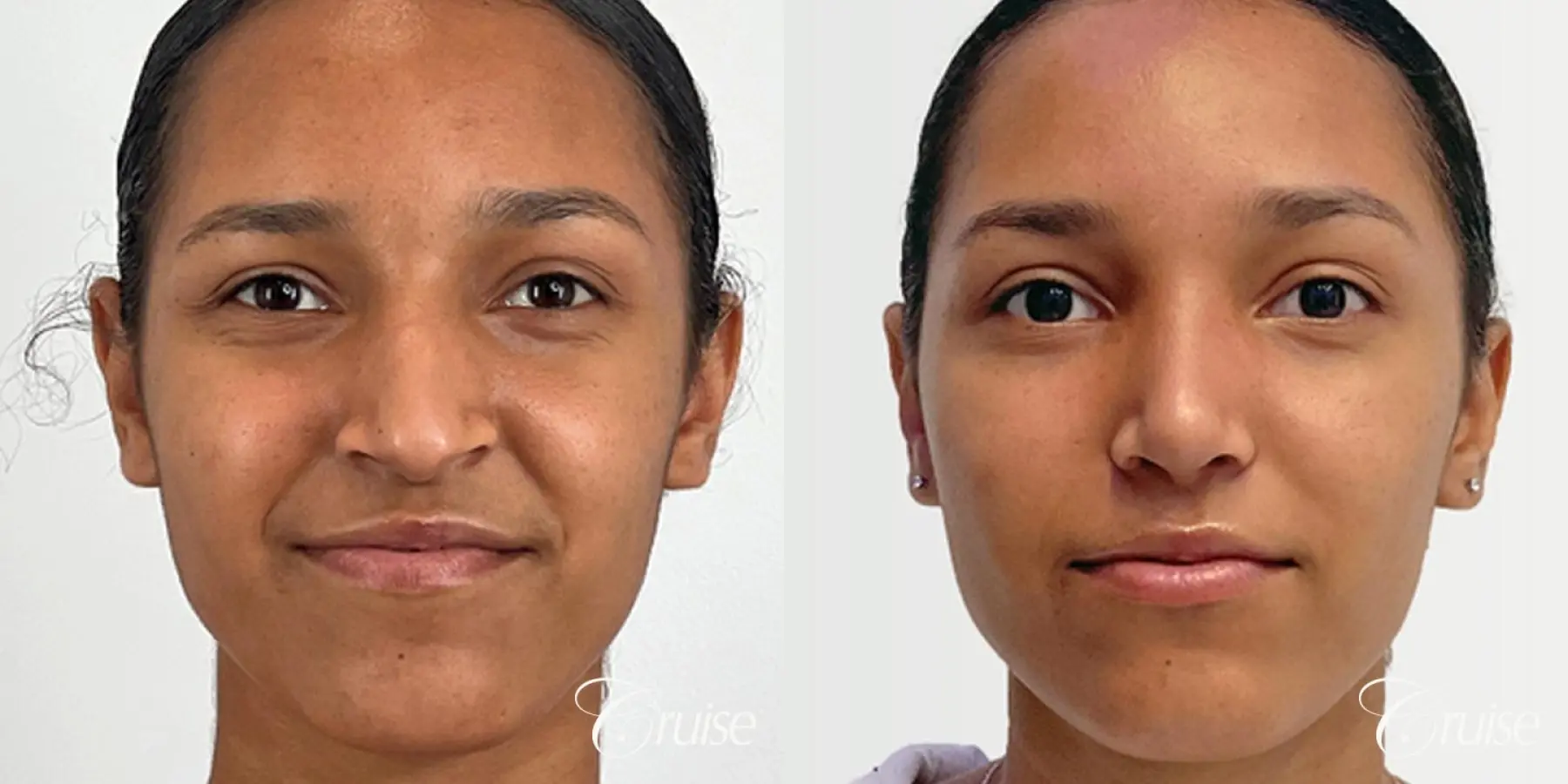 Open Ethnic Rhinoplasty - Before and After 2