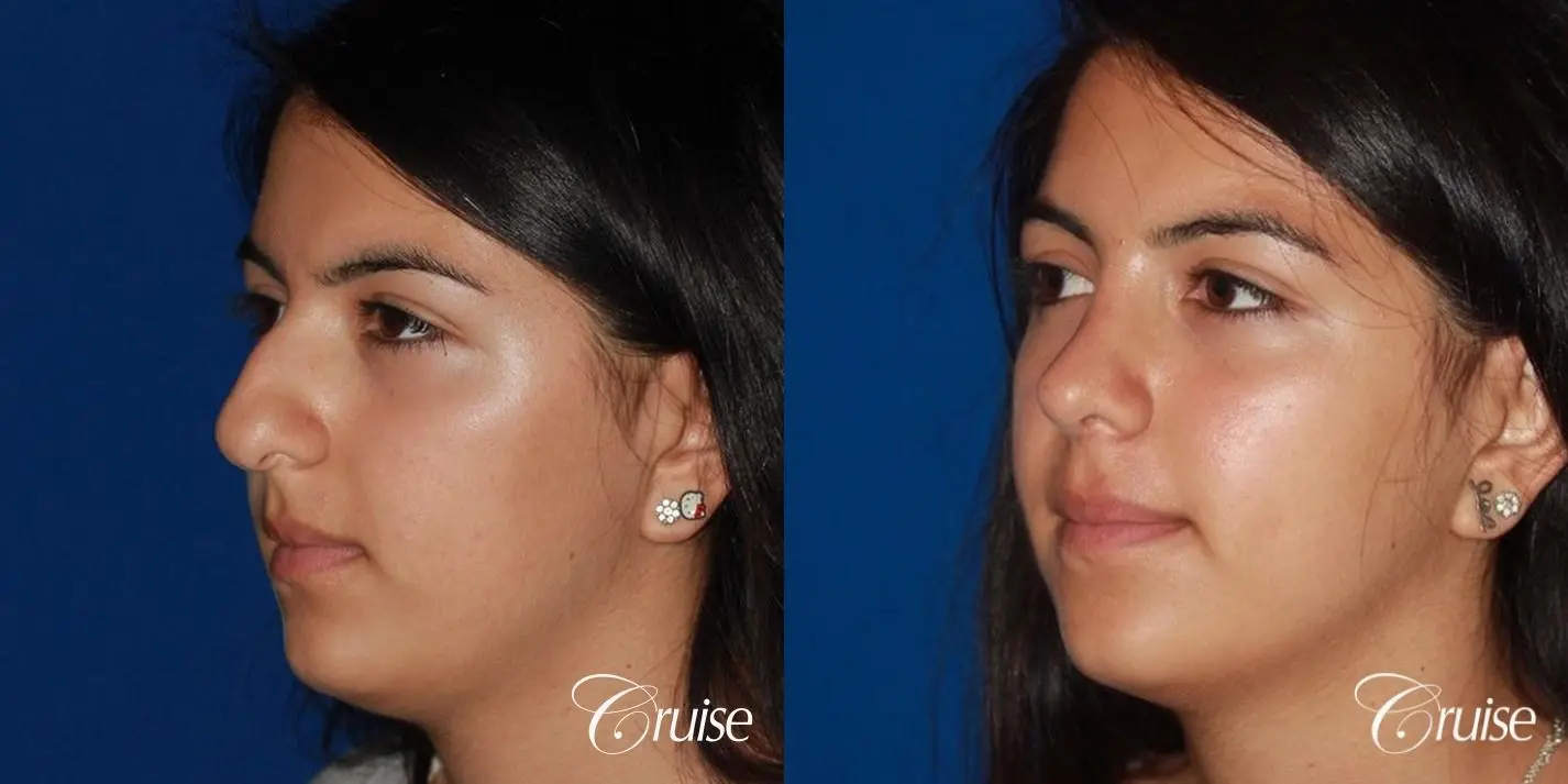 Rhinoplasty: Dorsal Hump & Droopy Tip Correction - Before and After 3