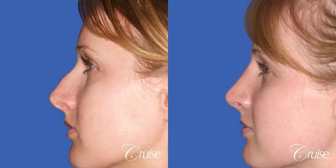 Rhinoplasty: Nose Reduction & Tip Narrowing - Before and After 2