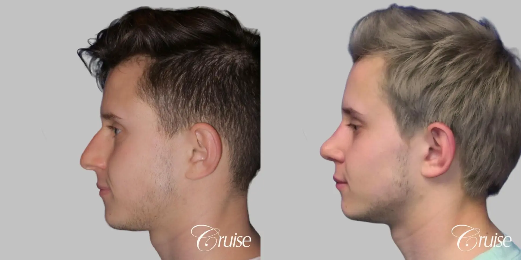 Rhinoplasty & Septoplasty Surgery - Before and After 2