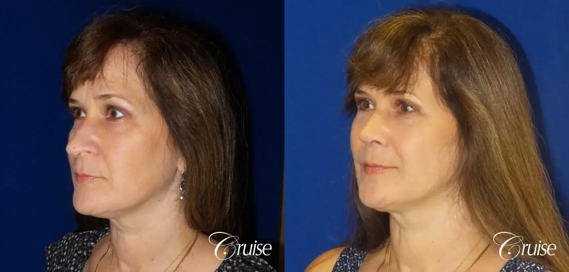 Rhinoplasty: Hump Reduction & Tip Shortening - Before and After 2