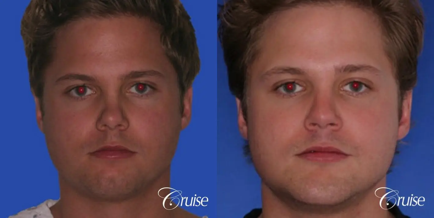 Rhinoplasty w/ Chin Augmentation: Tip Correction  - Before and After 1