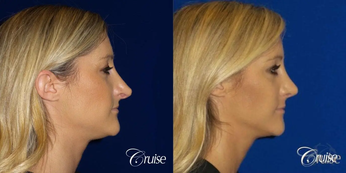 Best Rhinoplasty results Newport Beach CA - Before and After 2