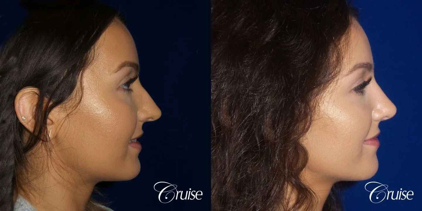 Rhinoplasty Dr. Cruise newport beach - Before and After 3