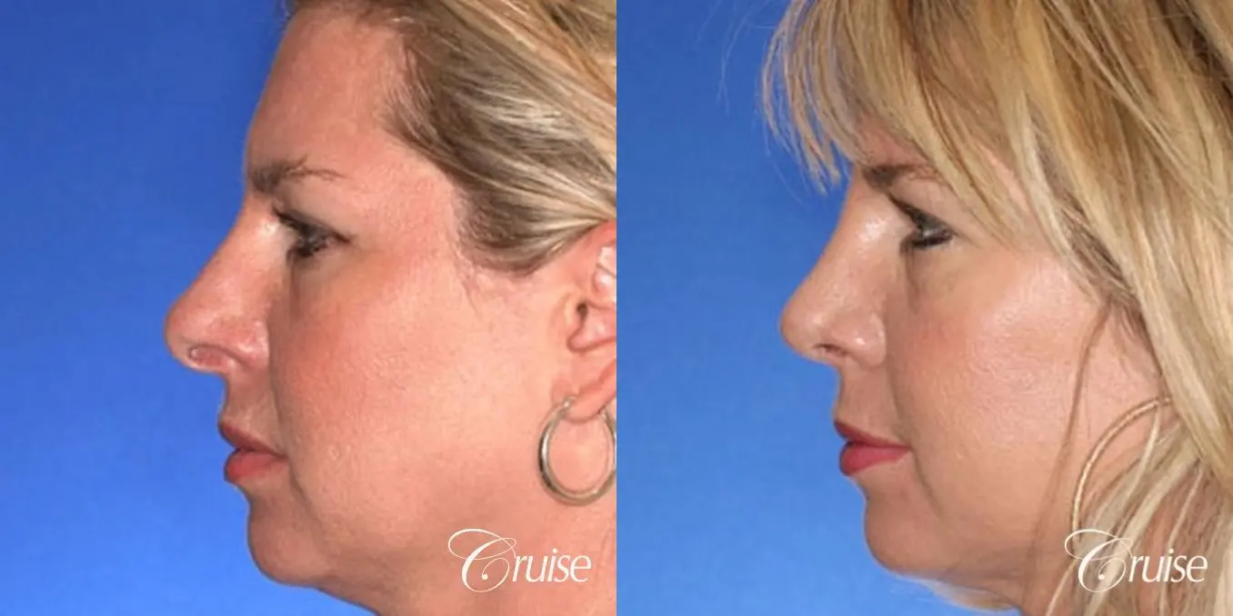 Rhinoplasty: Hanging Columella, Deviated Nose, Bulbous Tip Correction  - Before and After 2