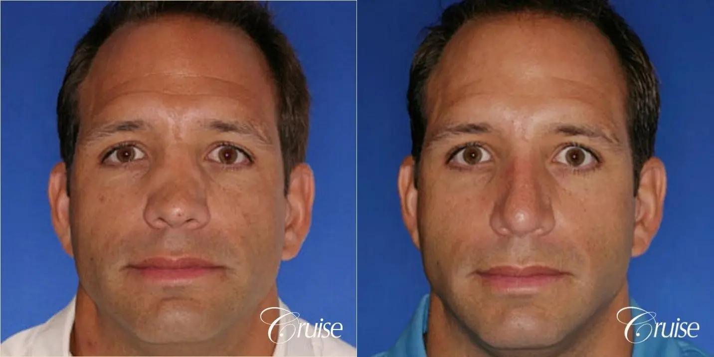 Rhinoplasty Revision: Correction of Ski Sope Deformity, Loss of Dorsal Lines - Before and After 1