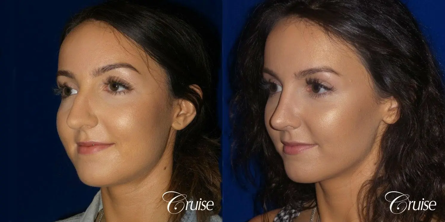 Rhinoplasty Dr. Cruise newport beach - Before and After 4