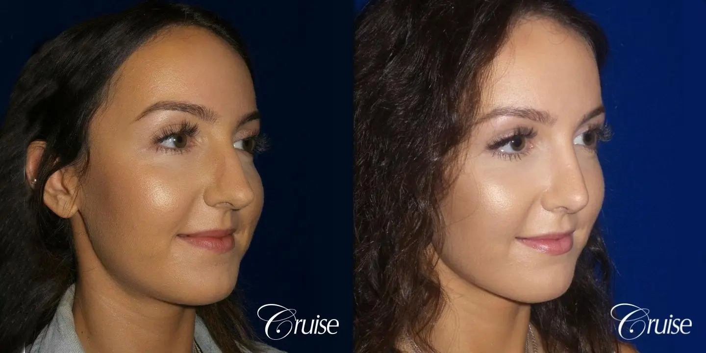 Rhinoplasty Dr. Cruise newport beach - Before and After 2