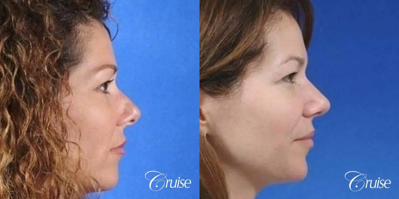 Rhinoplasty: Nose Lengthening & Bulbous Tip Correction - Before and After 2