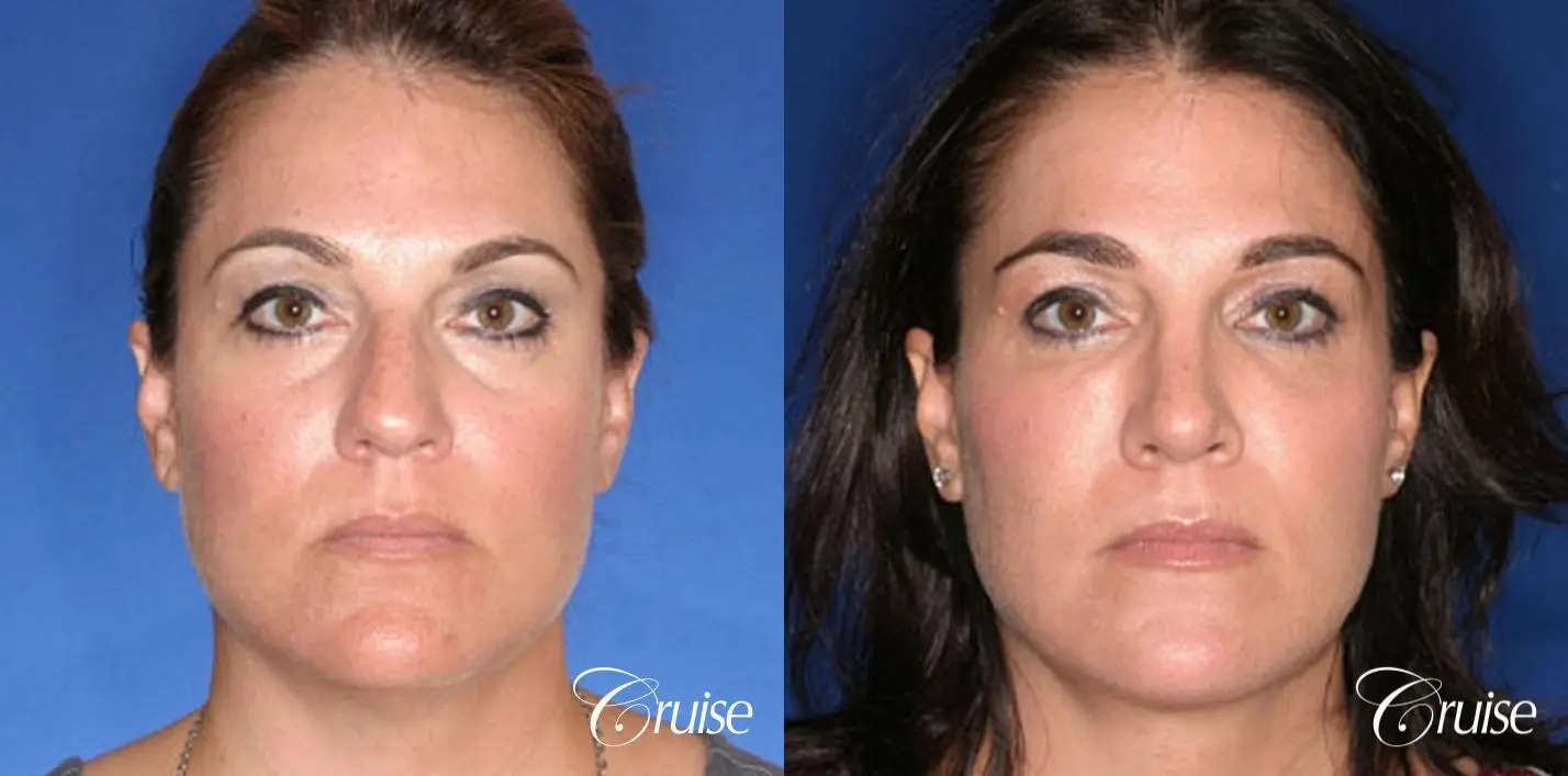 Rhinoplasty: Hump Reduction & Droopy Tip Correction  - Before and After 1