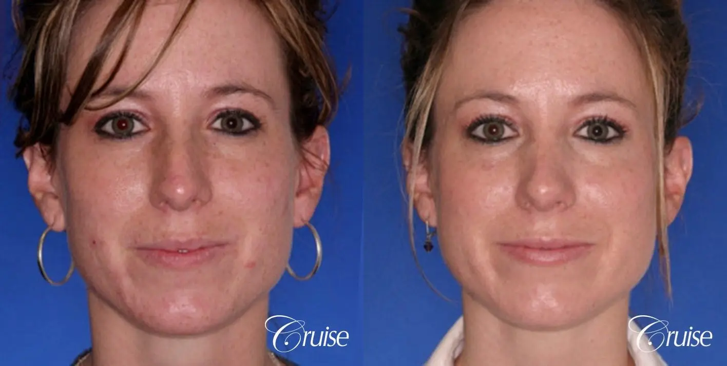 Rhinoplasty: Nose Refinement  - Before and After 1