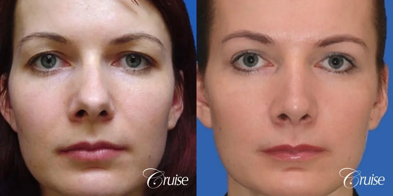 Rhinoplasty: Dorsal Hump, Nose Narrowing, Tip Definition  - Before and After 1
