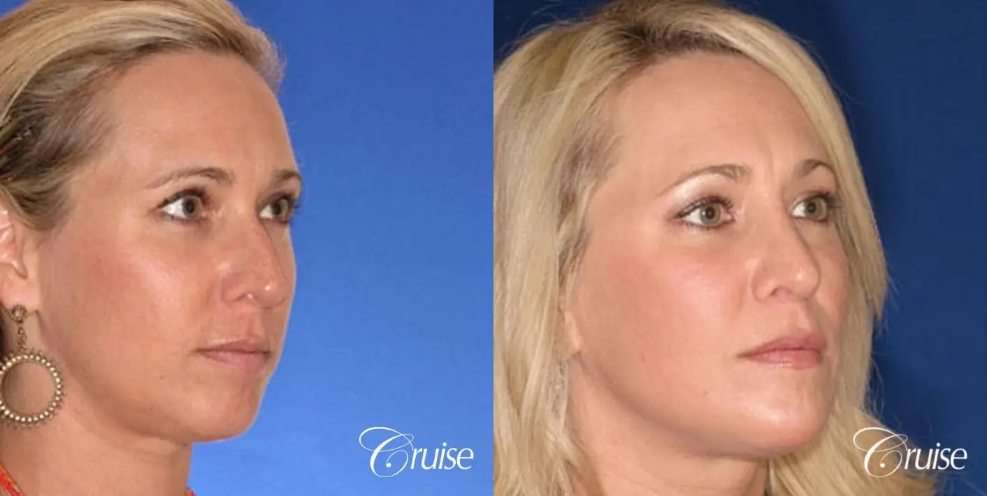 Rhinoplasty: Dorsal Hump & Droopy Tip Correction - Before and After 3