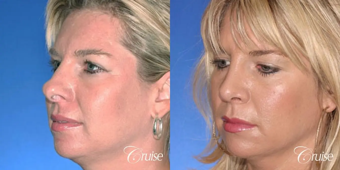 Rhinoplasty: Hanging Columella, Deviated Nose, Bulbous Tip Correction  - Before and After 3